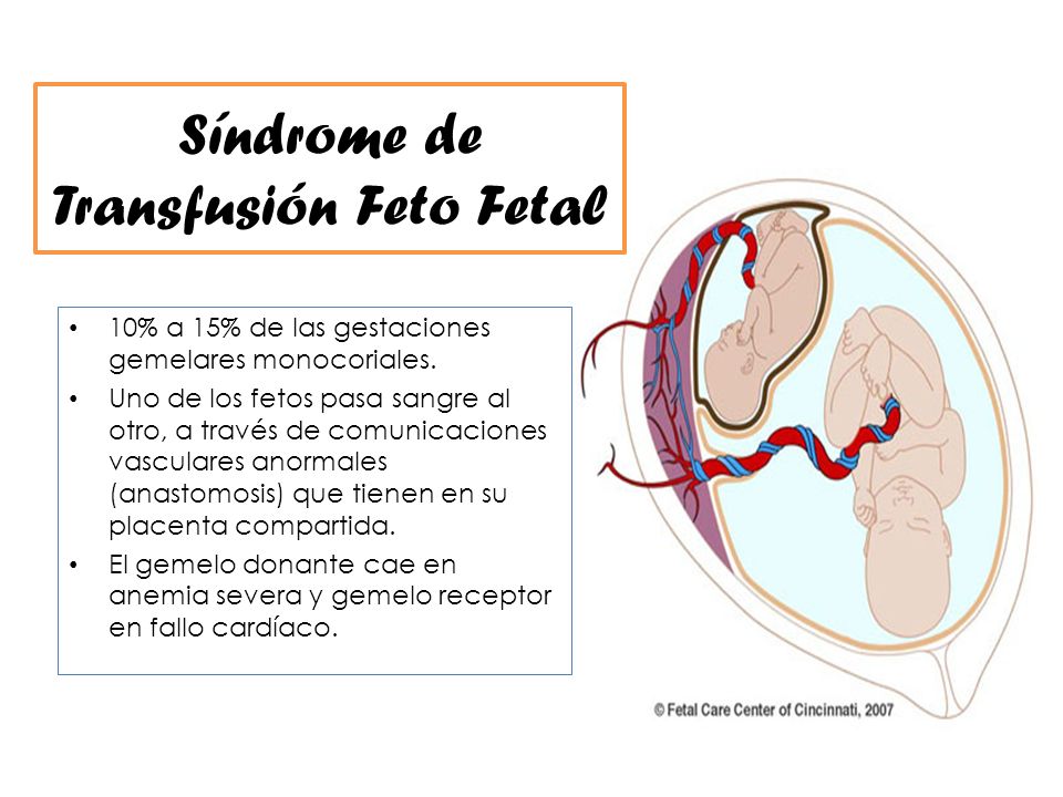 transfusión feto fetal sintomas de diabetes